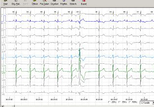 LZ-EKG Streifen