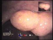 Polyp 1 fusion